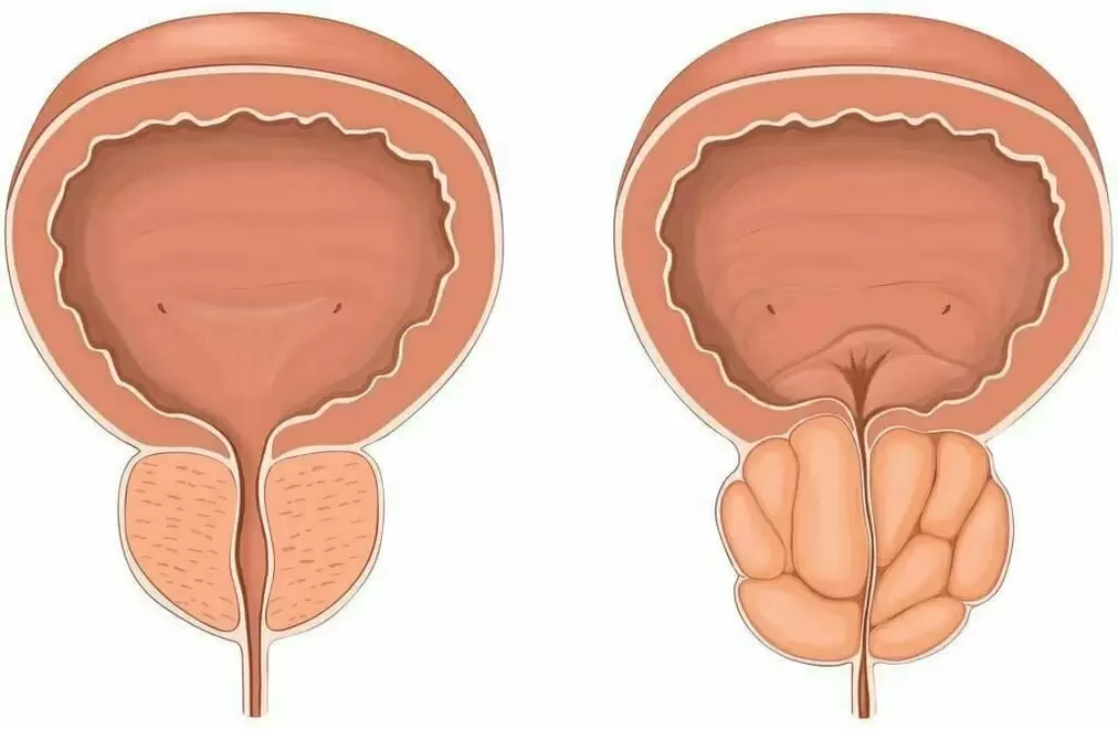 Healthy prostate and prostatitis
