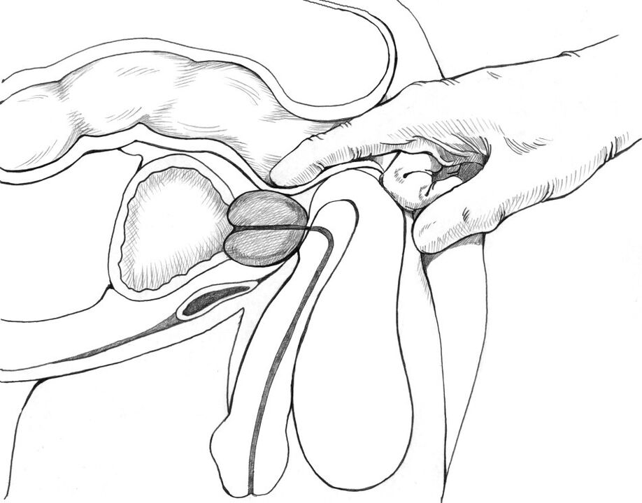 Prostate massage is included in the complex of prostatitis treatment methods